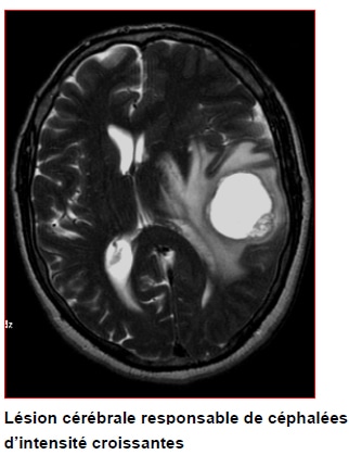 Céphalées - Hôpital Paris Saint Joseph