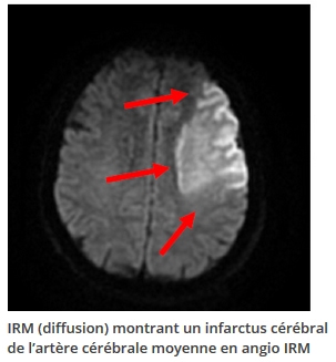 infarctus