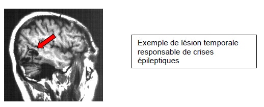 Epilepsie 2 neuro