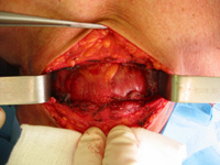 Anatomie de la thyroïde (vue chirurgicale)