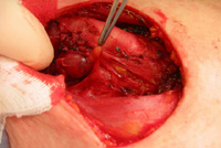 1- Parathyroïdie normale : petite glande brun-jaune au bout de l'instrument