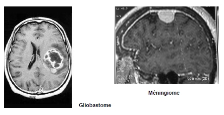 Tumeurs cérébrales - Méningiome cérébral - Hôpital Paris Saint Joseph