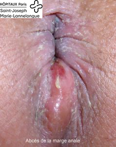 Fistules 1 absces1