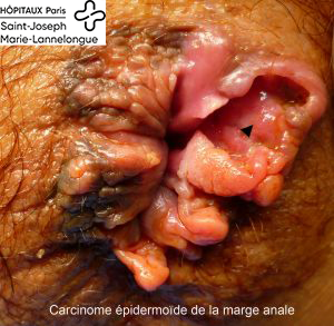 Pathologies pré et cancéreuses 2 carcinome