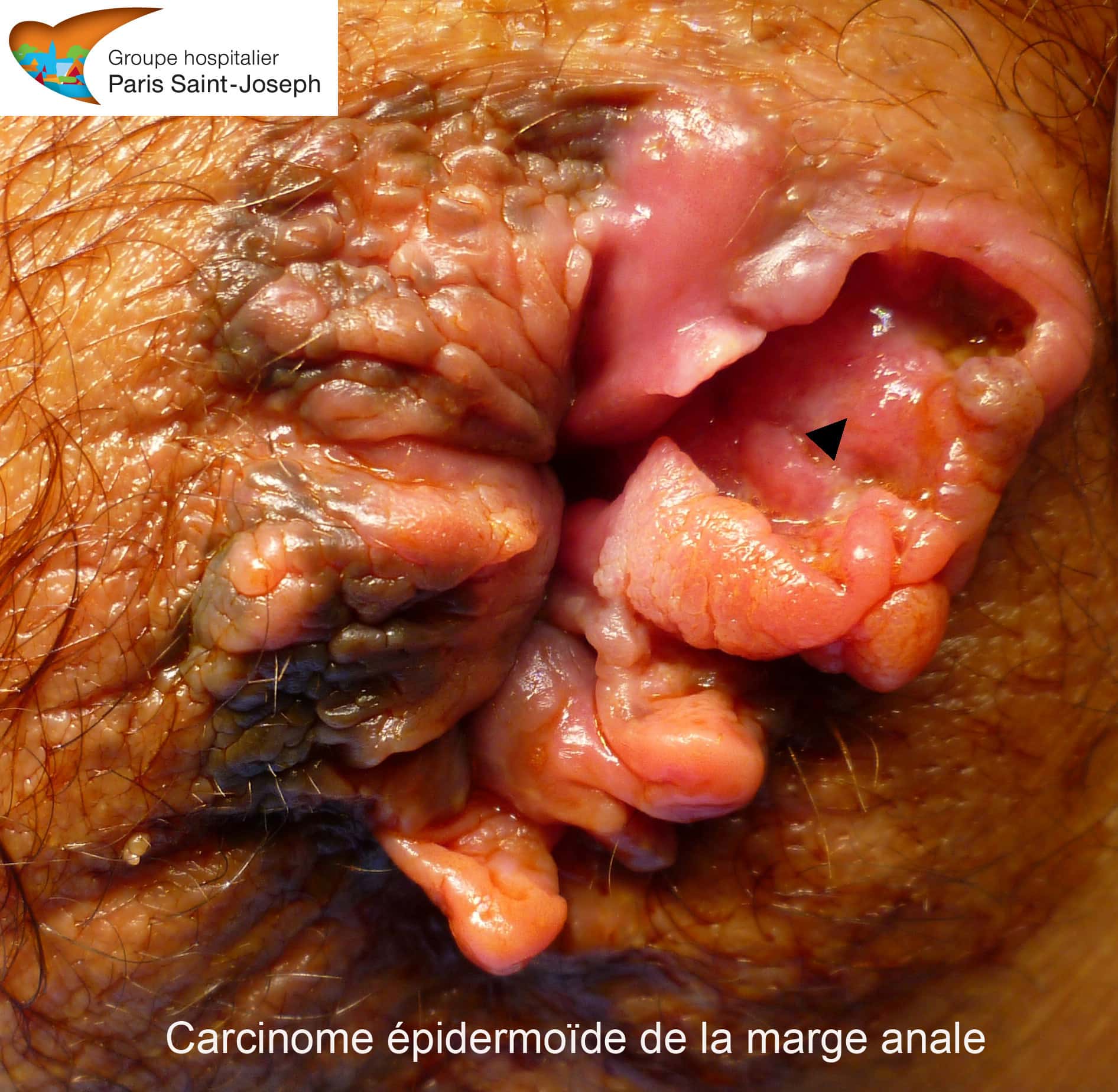 Colon lésions - Lésion du rectum et cellule précancéreuse dans le ...