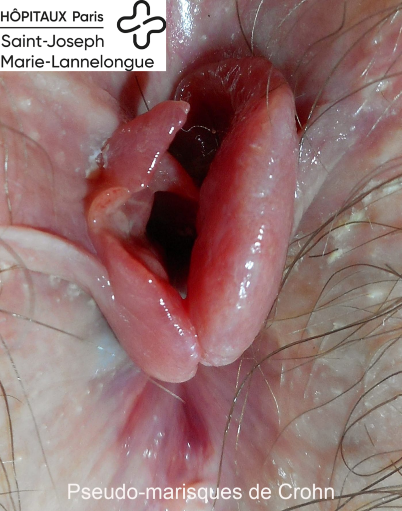 crohn2
