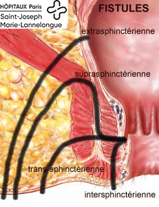 Fistules 4 fistules