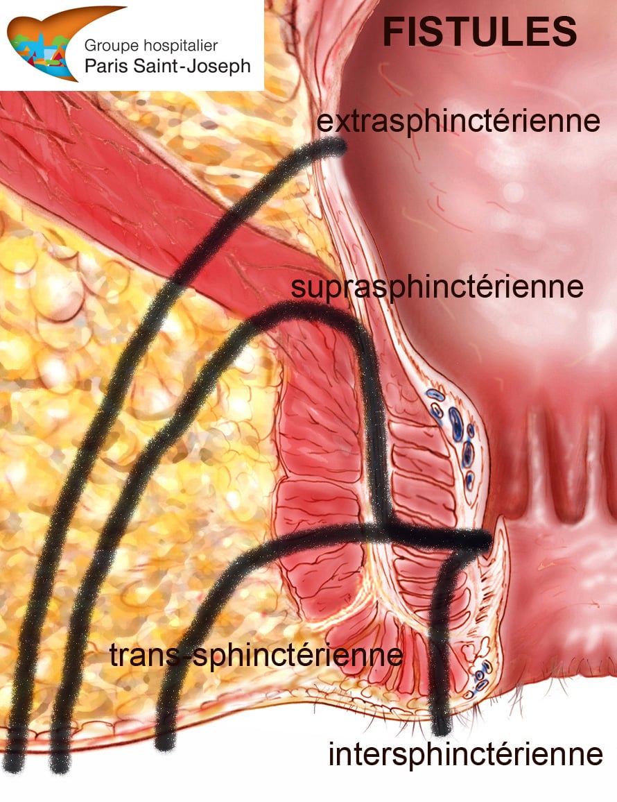 Fistules anales : traitement de la fistule, mise à plat d'abcès et ...