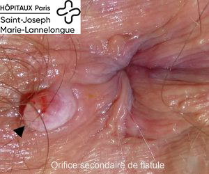 Fistules 3 ori_sec