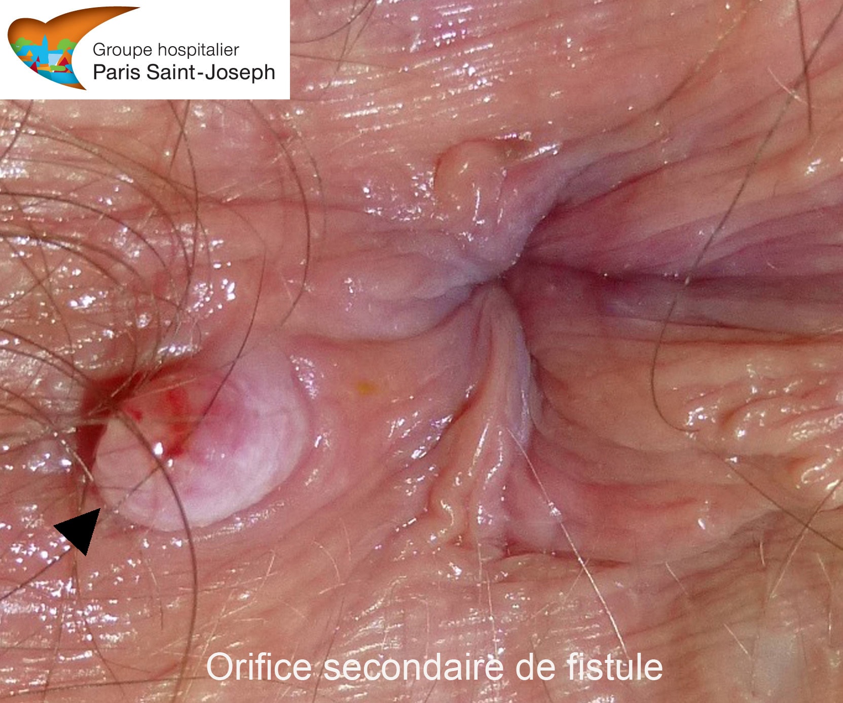 Fistules anales : traitement de la fistule, mise à plat d'abcès et ...