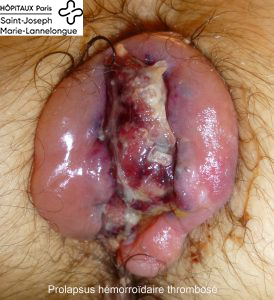 Pathologie hémorroïdaire 3 prolapsus