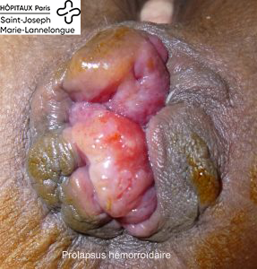 Pathologie hémorroïdaire 4 prolapsus2