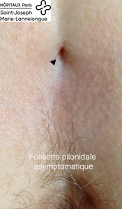 Sinus pilonidal 1 sinus