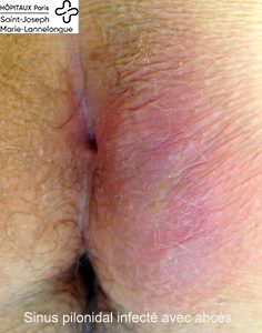 Sinus pilonidal 2 sinus1