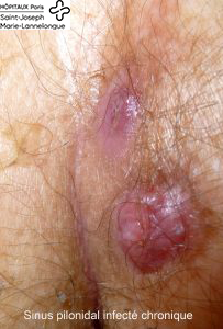 Sinus pilonidal 3 sinus2