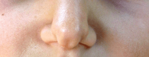 anomalie valve nasale