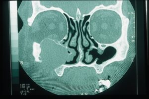 cancer sinus