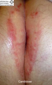 Dermatoses 3 candidose 182x300 1