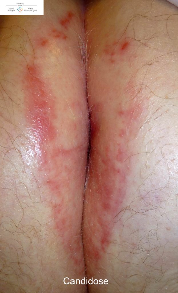 Dermatoses 3 candidose