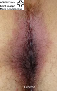Dermatoses 2 eczema 189x300 1
