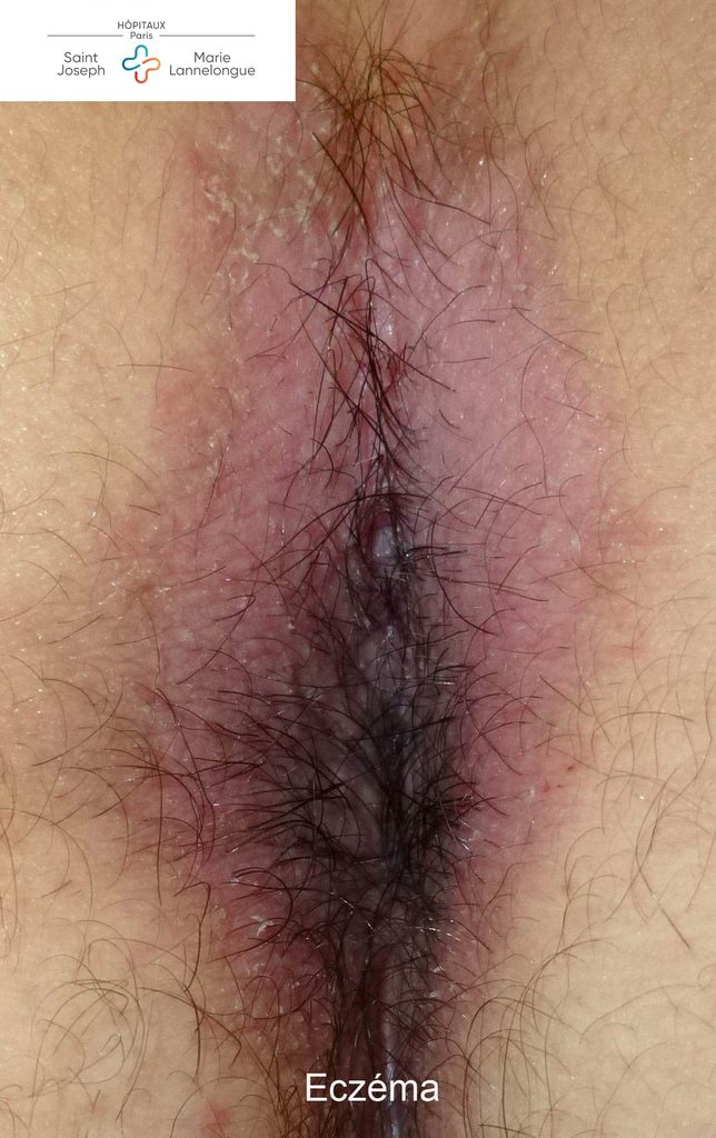 Dermatoses 2 eczema