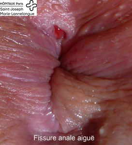fissure anale aigue 273x300 1