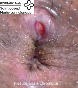 Fissure anale 2 fissure anale chronique 264x300 1