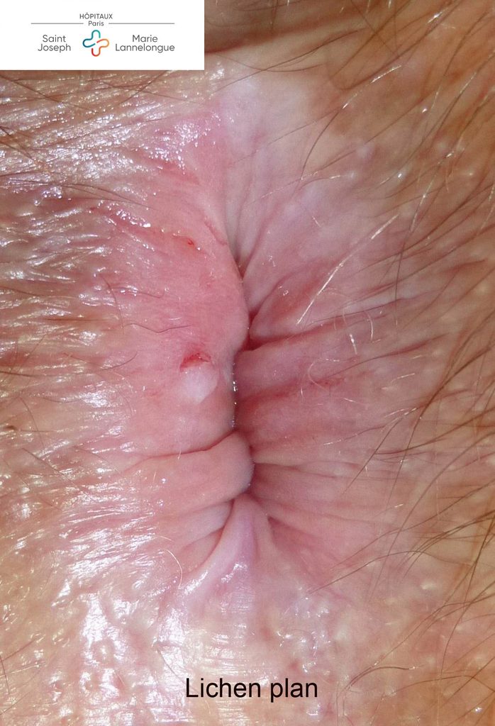 Dermatoses 5 lichen plan