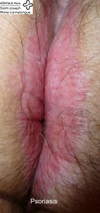 Dermatoses 4 pso 142x300 1