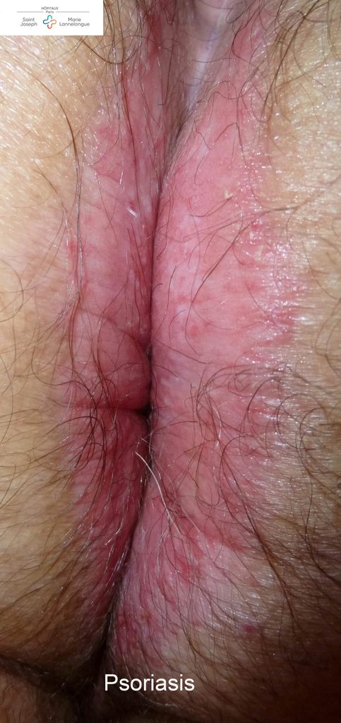 Dermatoses 4 pso