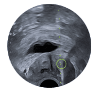 biopsie prostate