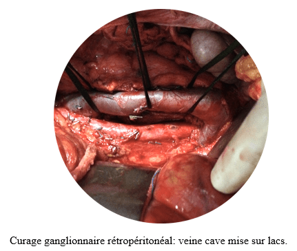 cancer testicule 1