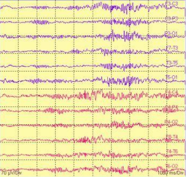 eeg2