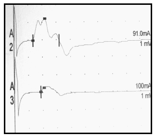 electromyogramme