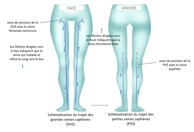 Généralités sur les varices - Hôpital Paris Saint‑Joseph