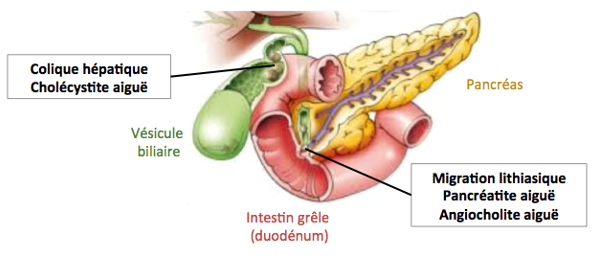 lithiase