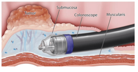 resection2