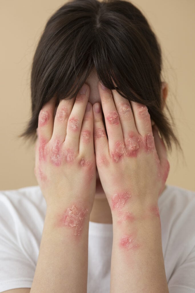 Mains atteintes de psoriasis
