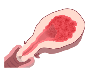 Cancer de l'endomètre 2 image 2