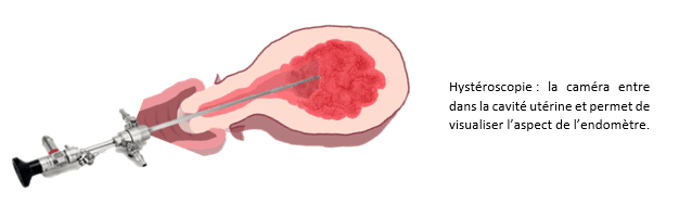 Cancer de l'endomètre 3 image 3