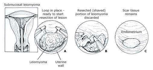 Les fibromes utérins 5 resection