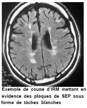 Douleurs neuropathiques sclérose en plaques