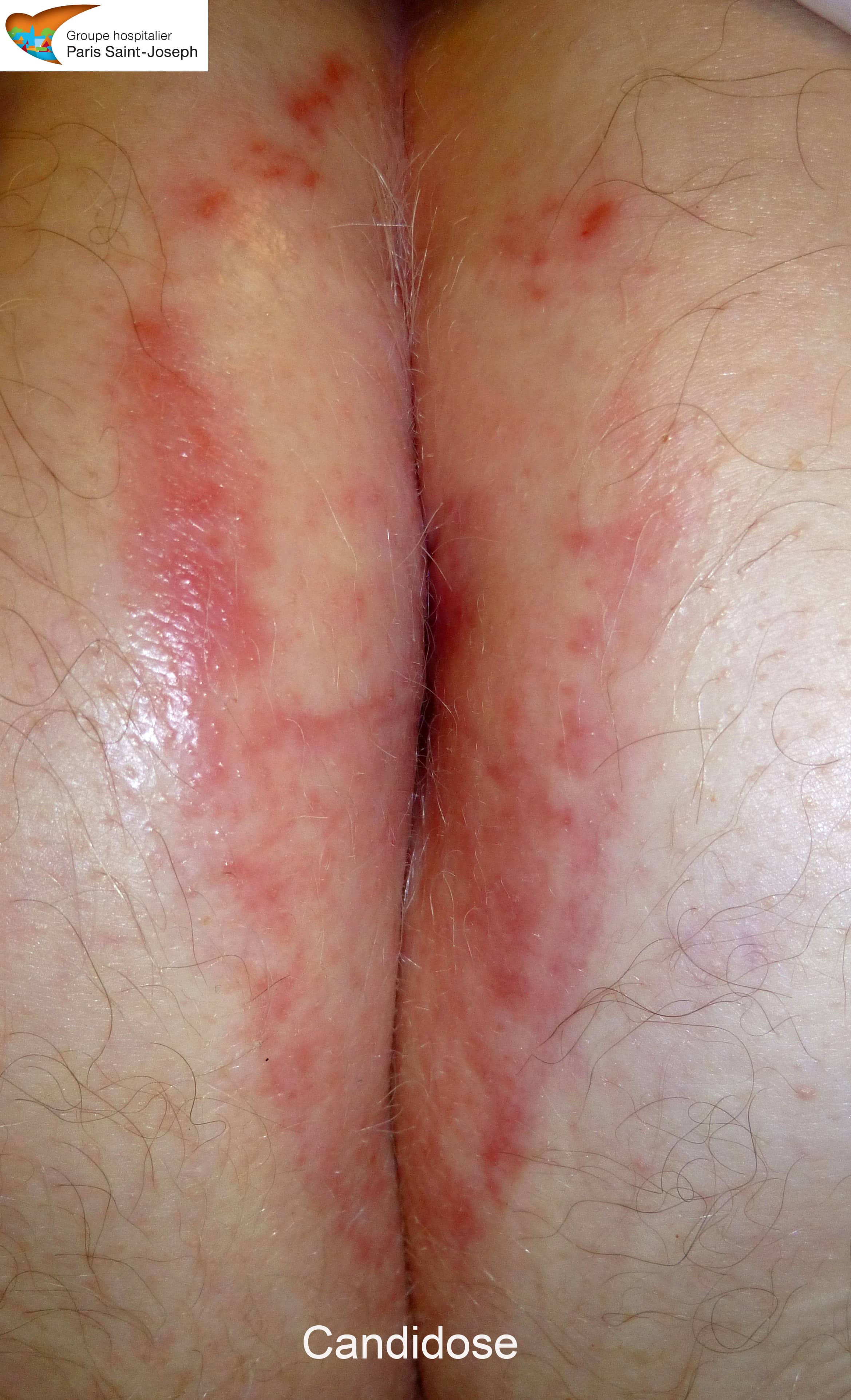Dermatoses anales : traitement des lésions dermatologiques de l ...