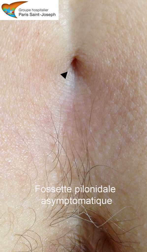 Sinus pilonidal fossettes pilonidales et risques d