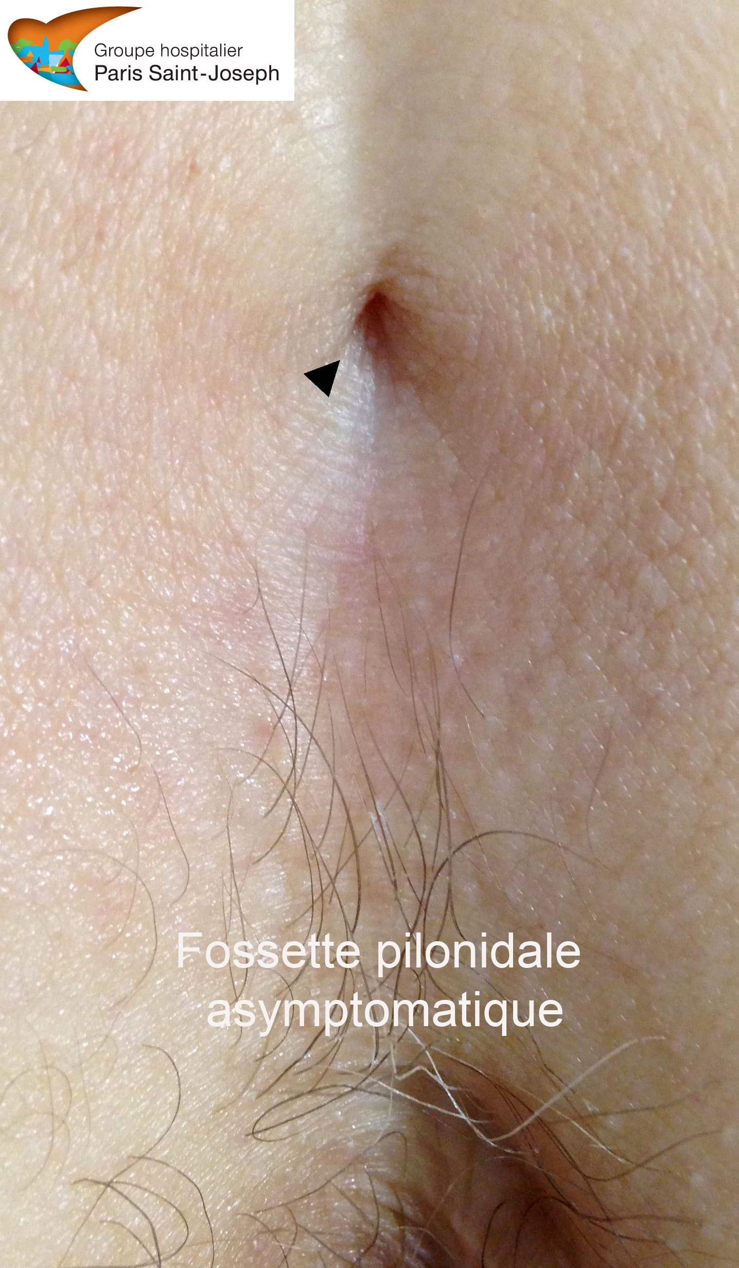 Sinus pilonidal : fossettes pilonidales et risques d'infection ...