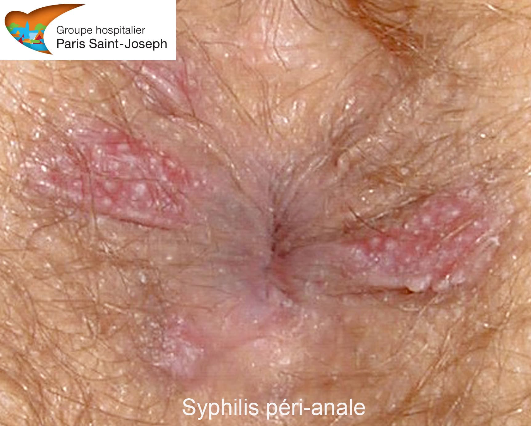 hpv anale symptomes natural treatment of papillomavirus