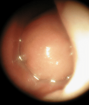 Bilan D Une Obstruction Nasale Hopital Paris Saint Joseph