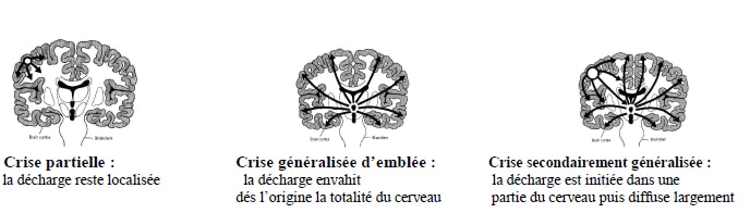Epilepsie 1 neuro1 1