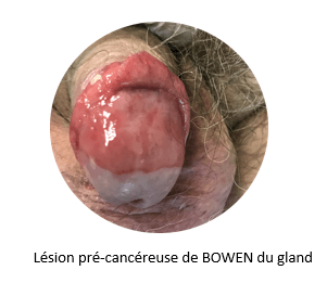 Papillomavirus ganglions symptomes - mobilserv.ro, Papillomavirus ganglions symptomes