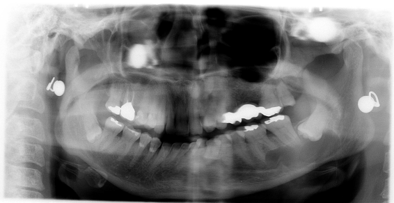 dents sagesse